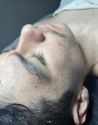 Acne facial! Perfect for acneic skin that wants to remove redness and bacteria.