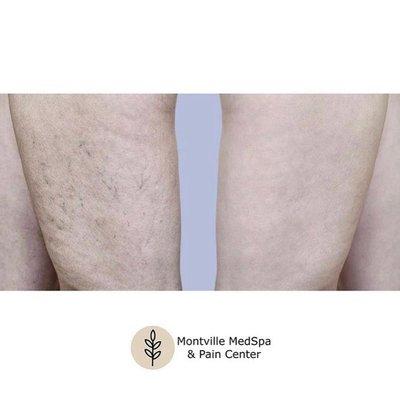 Montville MedSpa & Pain Center Vein Treatment Therapy Before and After