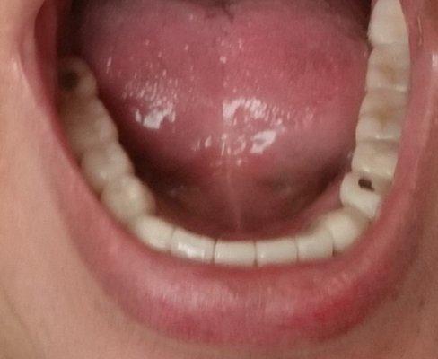 Expecting white vaneers, Dr laughed silver filling matched grinded tooth Dr Burquez  Refused to fix without more money!!!