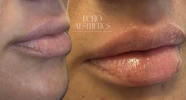 Mini lip plump. Perfect solution for clients that just need a little hydration & balancing for perfect symmetry!