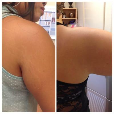 Stretch Mark Treatment after three sessions