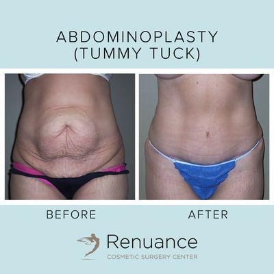 Tummy Tuck at Renuance Cosmetic Surgery Center & Medical Spa in Murrieta, CA