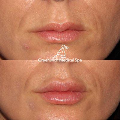 Your solution to fuller lips may include Restylane Kysse, Juvéderm Ultra XC, Volbella, or BOTOX injections.