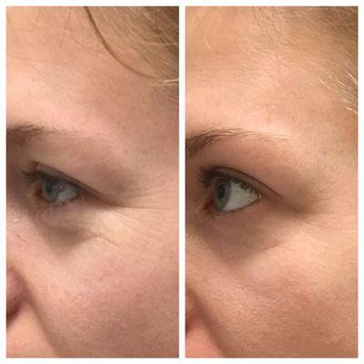 Before and after 3 treatments of microneedling.