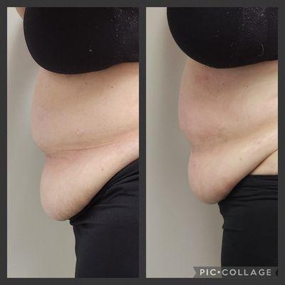 Breaking down fat with cavitation!