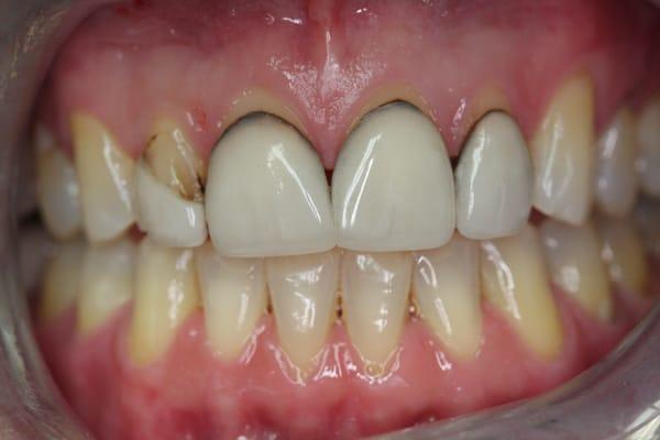 Before photo of a patient that had multiple failing old crowns and veneers that made it difficult to smile.