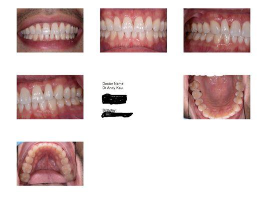 Invisalign After