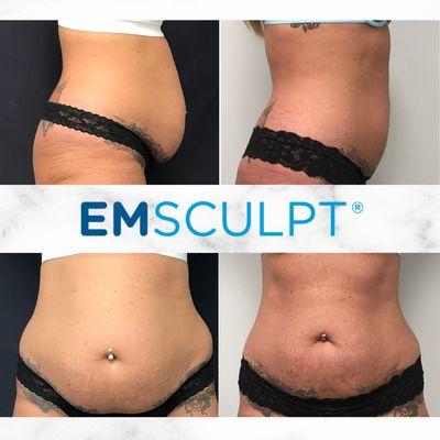 Before and after 8 EMSCULPT body contouring treatments.