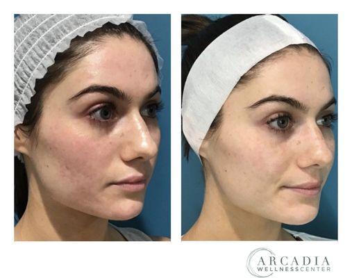 Before and after one treatment of Microneedling!