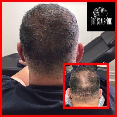 Hair transplant scar using scalp micro pigmentation