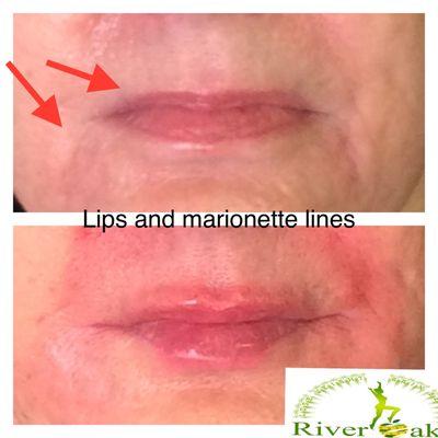 Lips and marionette lines filler