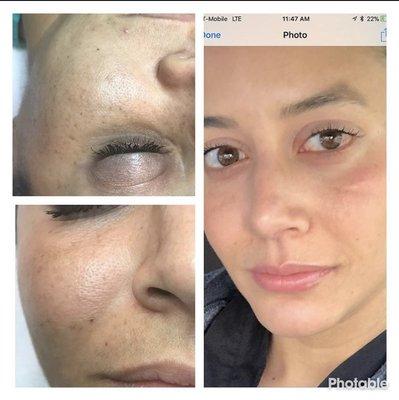 Microneedling with Dermapen
Radiofrecuency
Melaspeel 
Microneedling with Nano Pore Stylus