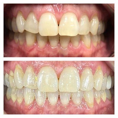 Through Invisalign, we were able to straighten the patient's teeth and improve their bite.