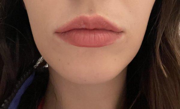 My beautiful filled lips!!