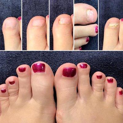 Damaged toenail reconstruction before and after