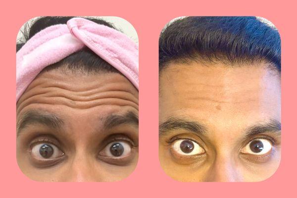 Wrinletox and Linefill Duo Treatment for the most natural looking male forehead by Marie Jin, AG ACNP-BC.