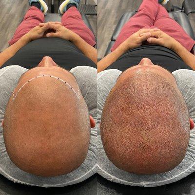 Lunar Scalp Micro Pigmentation