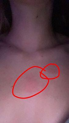 Marking on my chest from getting smacked