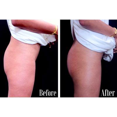 The Brazilian Butt Lift is one of Dr. Kim's specialties.  It is a non surgical procedure to increase volume, shape and lift the butt.