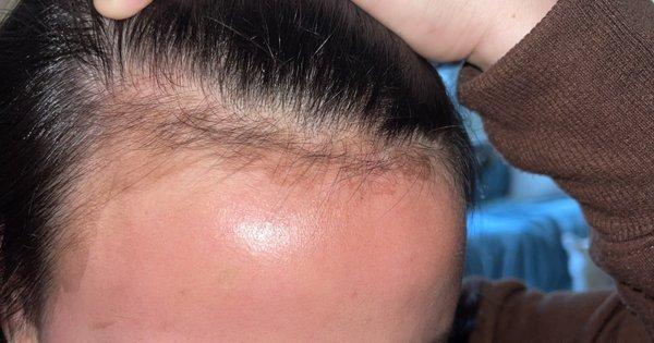 Dye stained forehead