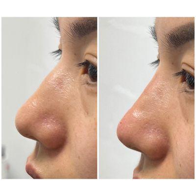 Nose filler to straighten out a bumpy nose