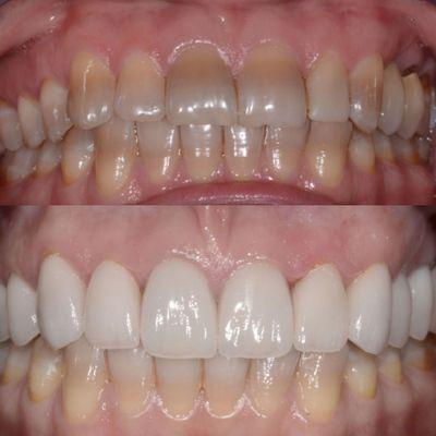 Dental Crown Transformation!  See the incredible difference in our latest before-and-after case. Our Cosmetic Dentist was able to help!