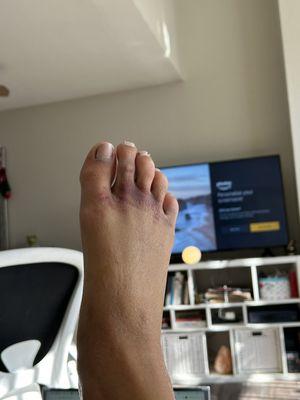 My foot after their spin class