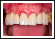 Dental Crowns in Port Lavaca, TX