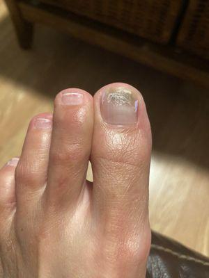 Big toenail that has a fungus