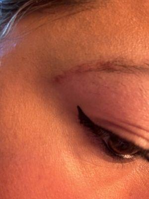 Chemical burn , eyebrow