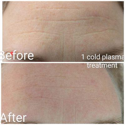 Cold plasma pen facial decreases fine lines and wrinkles