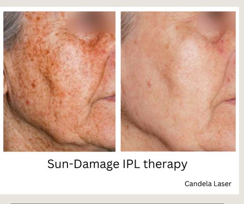 IPL light therapy for sun damage.