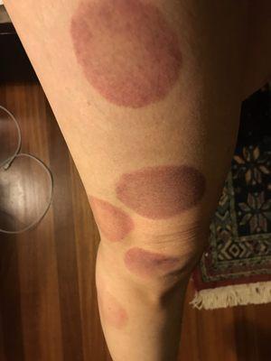 Cupping results due to knee pain