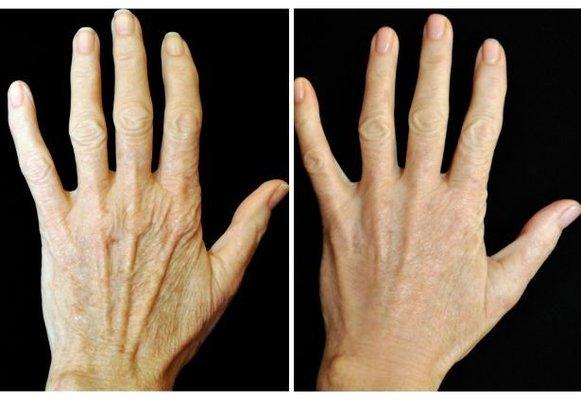 Dermal fillers for hand rejuvenation.