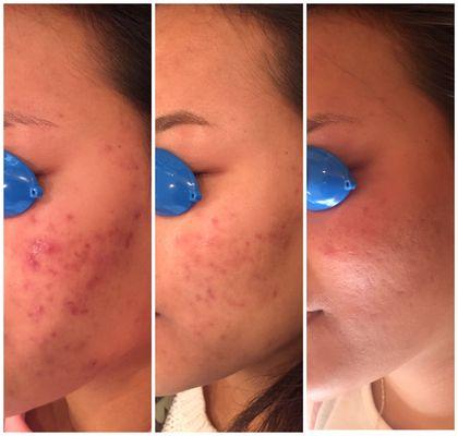 Acne Free Program