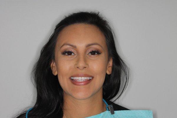 Invisalign -After Photo: Overlapped crowded teeth/ smile transformation complete! Call to schedule your Invisalign consult today!