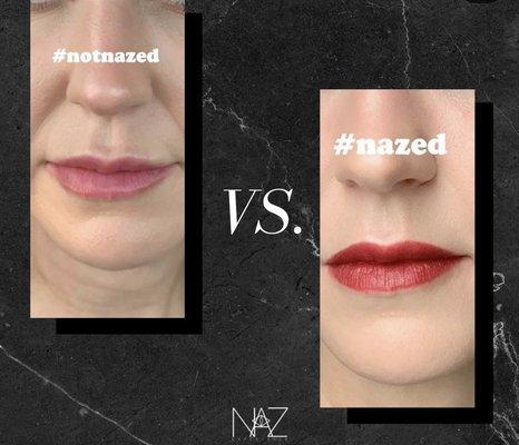 Patient with Nazed lips after fillers.