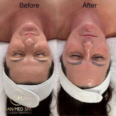 Before and after one treatment only with our Non surgical facelift treatment and organic peel add on