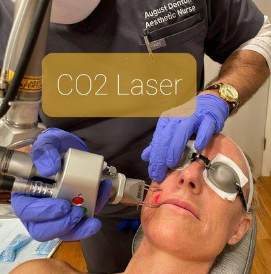 Fractioned CO2 Laser treatment process