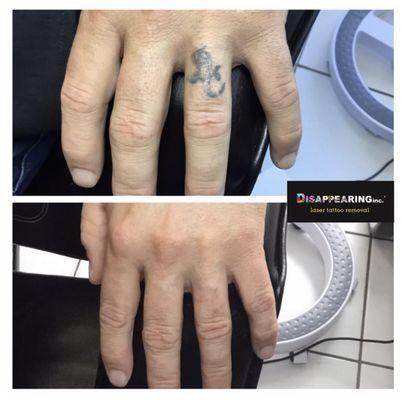 When you no longer want that tattoo on your ring finger, we are here to help.