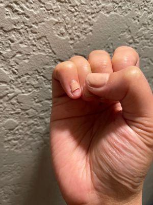 Broken nail