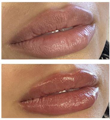 Before & After Lip Filler (half syringe)