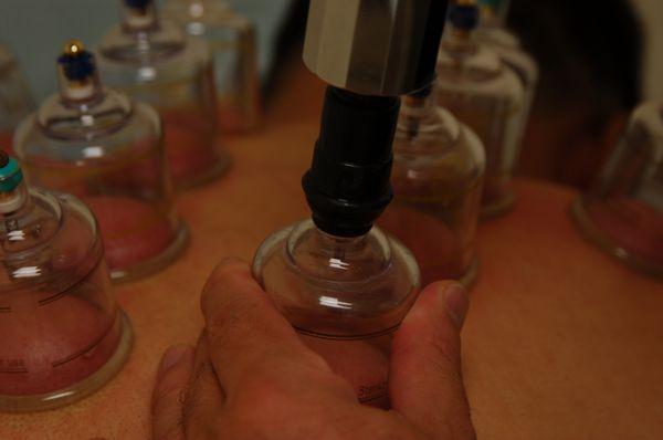 Cupping Treatments