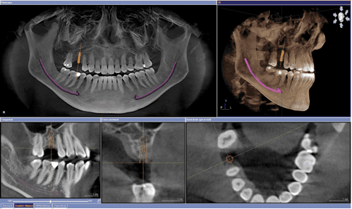 CT Scan & 3D Imaging for Implants and wisdom teeth surgeries.