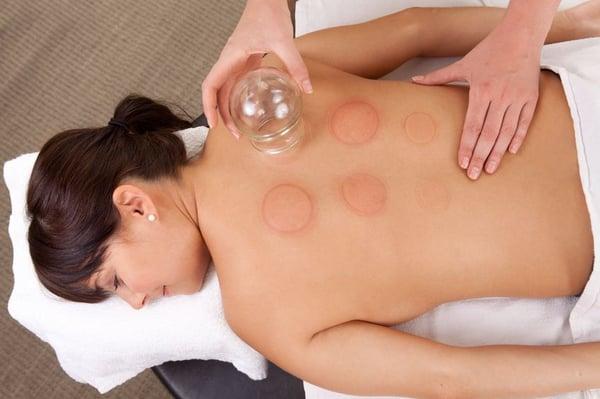 Cupping Treatment