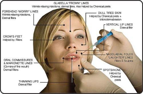 Botox, Dysport, Facial Fillers