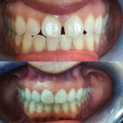 Invisalign treatment under 1 year !