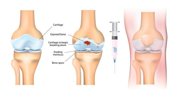 Stem Cell Injections for cartilage damage.