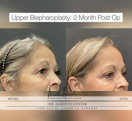 Before & After: Upper Blepharoplasty