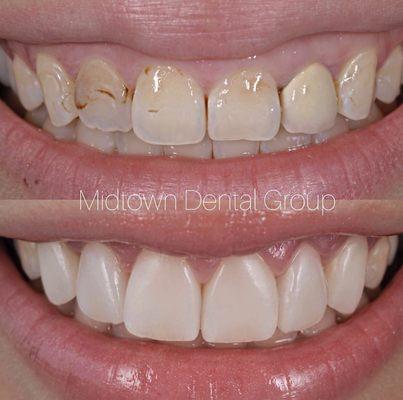 Replacement of worn down bondings into beautiful porcelain veneers! -Dr Daniell Mishaan